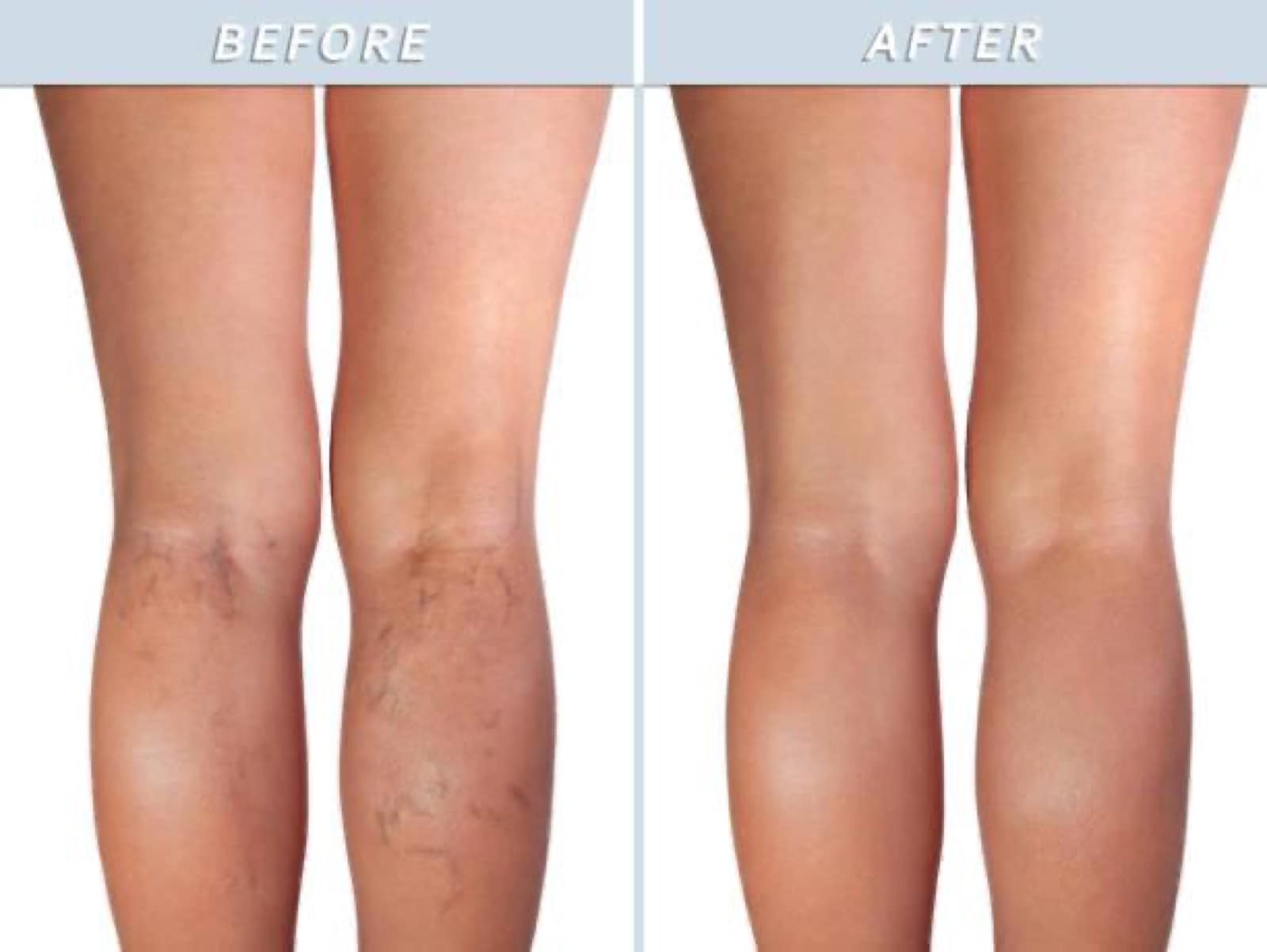 Documented vein treatment outcomes at an accredited practice