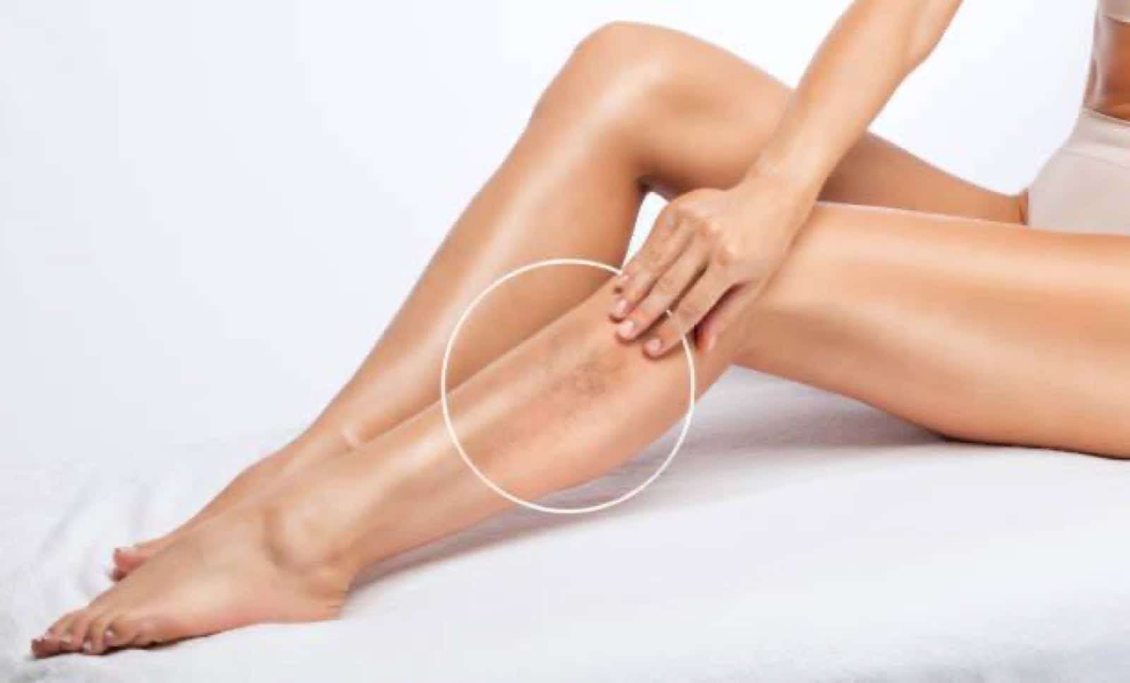Patient leg assessed for varicose and spider veins
